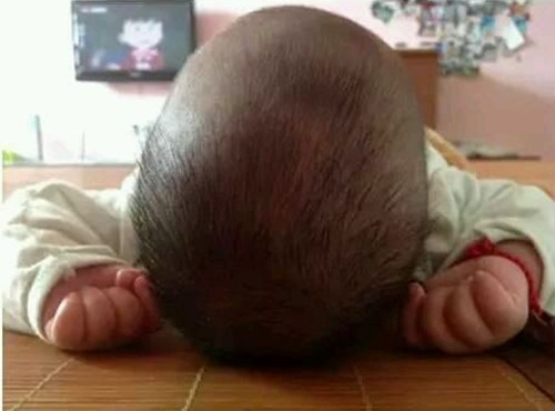 宝宝摔下床后脑淤血,孩子摔下床脑震荡表现