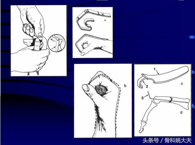 手肌腱损伤图片,手外伤神经肌腱损伤怎么定残