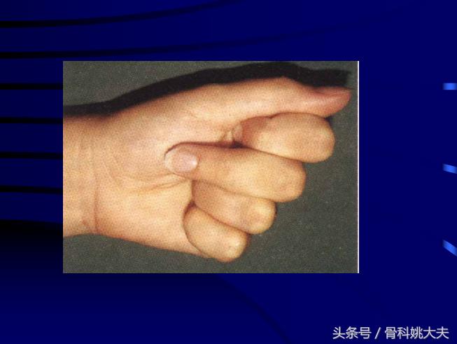 手肌腱损伤图片,手外伤神经肌腱损伤怎么定残