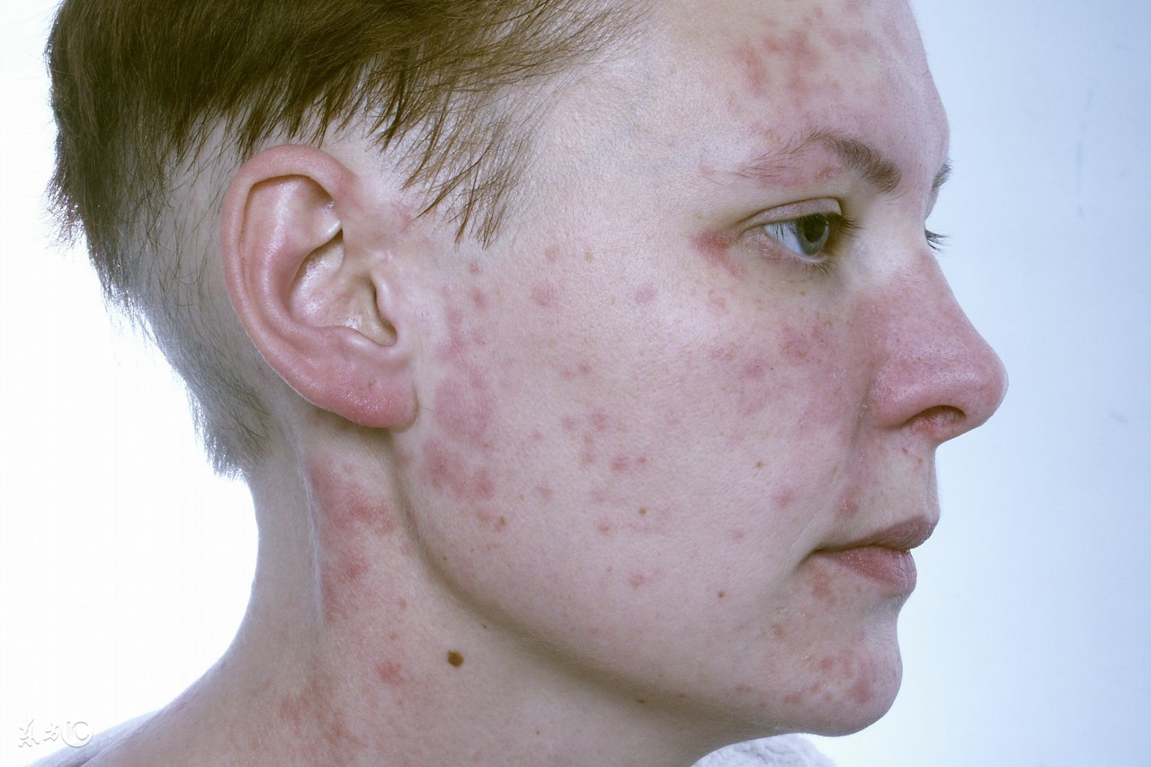 孕妇青霉素和头孢都过敏该怎么办,孕妇能用头孢青霉素吗