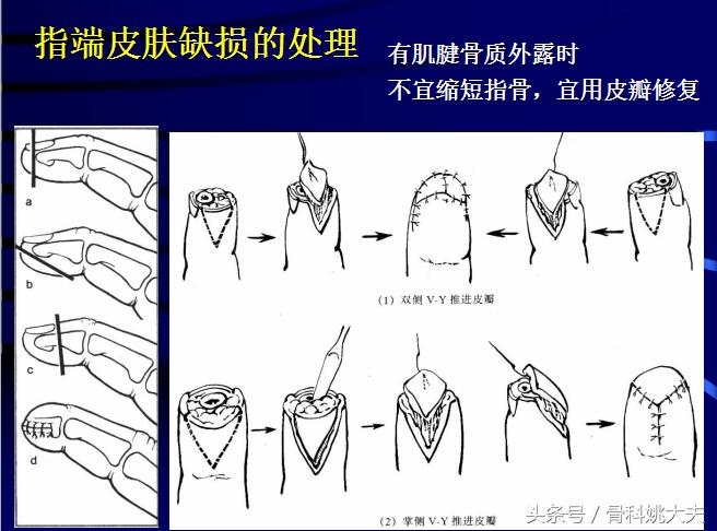 手肌腱损伤图片,手外伤神经肌腱损伤怎么定残