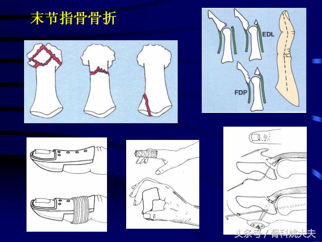 手肌腱损伤图片,手外伤神经肌腱损伤怎么定残