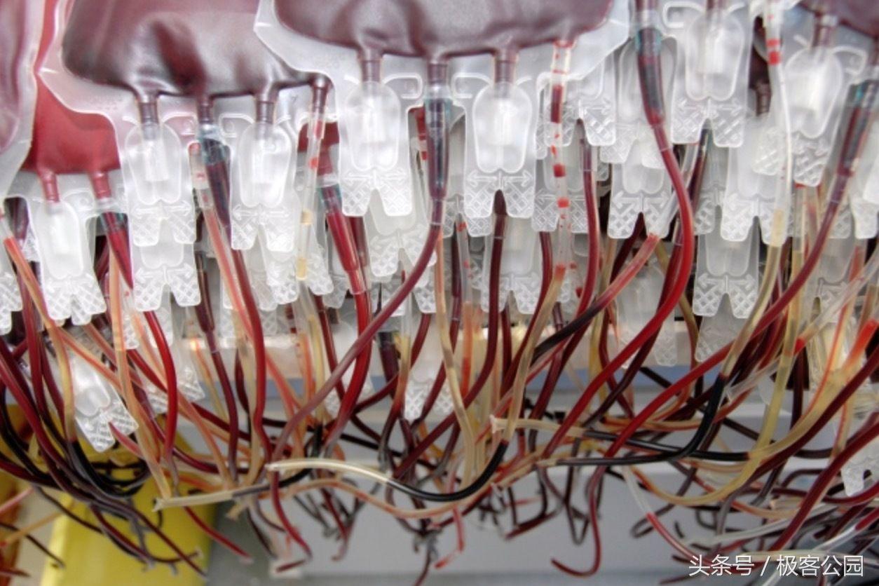 输入年轻人的血治疗老年痴呆,老年人血液粘稠换血治疗