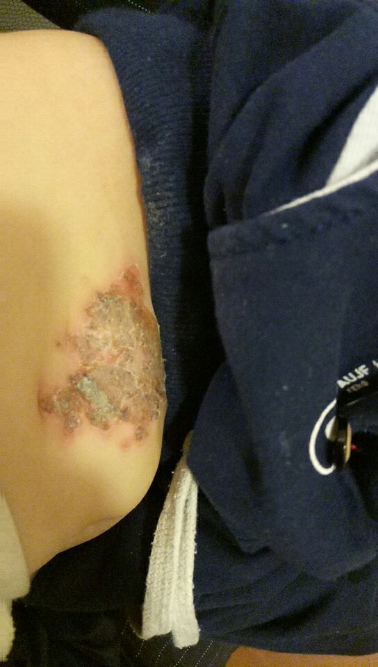 宝宝抓破皮流脓怎么处理,宝宝手被蹭破皮了要不要打破伤风