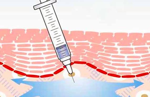 人咬人咬破皮需要打破伤风吗,为什么咬人会得破伤风