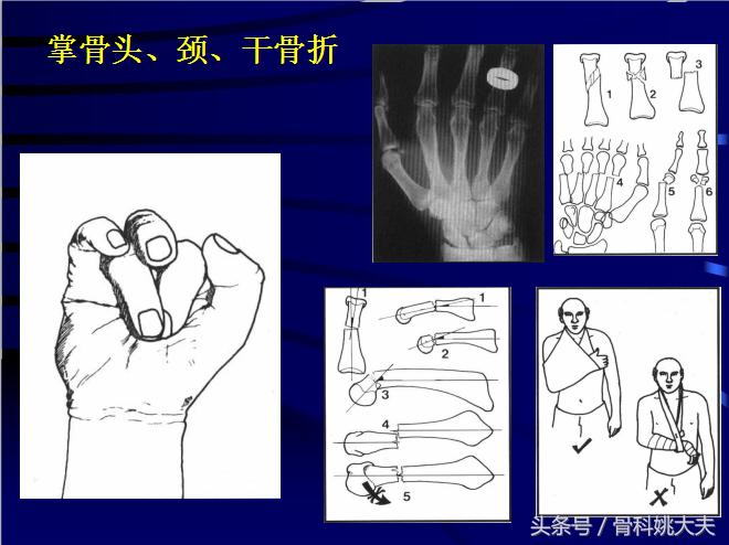 手肌腱损伤图片,手外伤神经肌腱损伤怎么定残