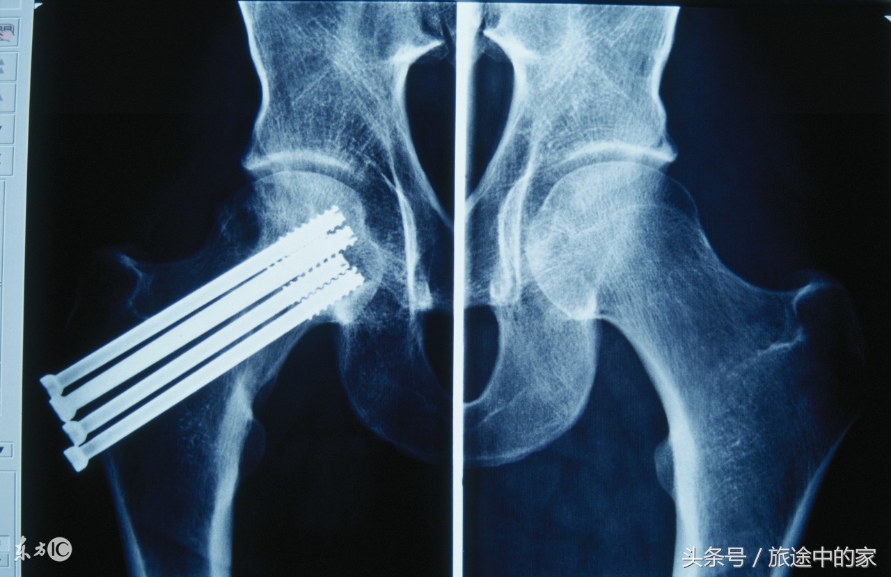 骨质钙化预防,骨质疏松的正确食用方法