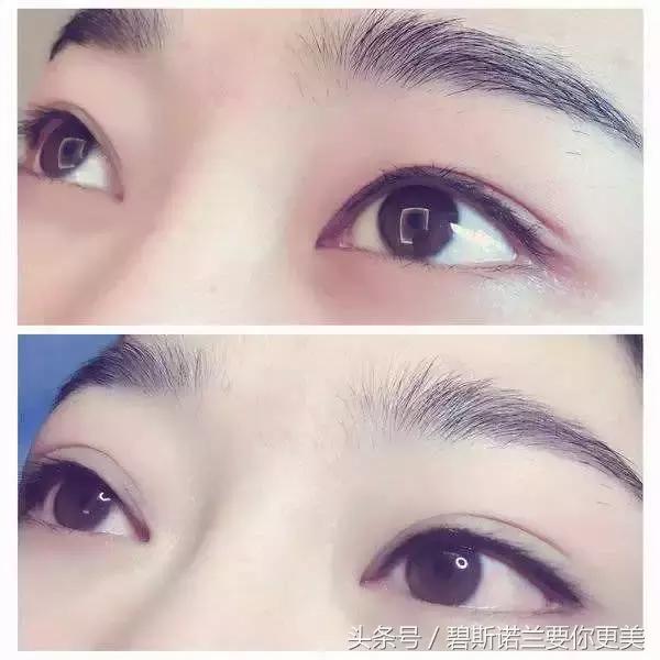 做了美瞳线双眼皮不见了,美瞳线做完1-7天肿胀的对比图