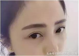 做了美瞳线双眼皮不见了,美瞳线做完1-7天肿胀的对比图