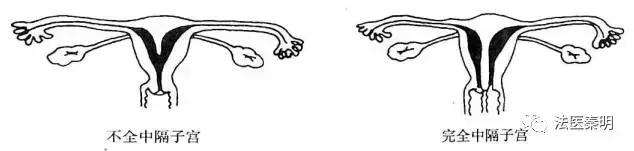 女人有两个子宫怎么办,有两个子宫怎么治疗