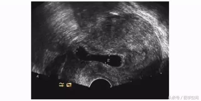 瘢痕妊娠的三维彩色超声图像,内生型瘢痕妊娠超声诊断标准