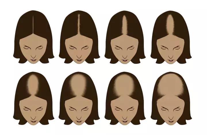 总是担心自己要秃了,怀疑自己越来越秃