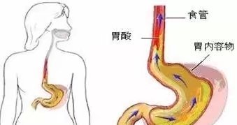 胃反流的偏方,治胃反流的药有哪些