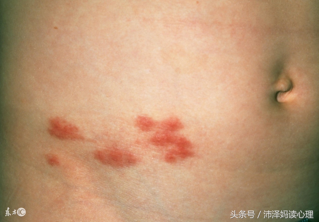 儿童最常见的十大传染病,儿童传染病最严重的排行