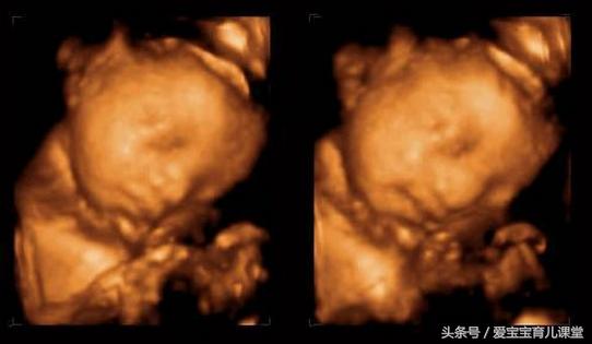 怀孕38周胎儿绕颈2周怎样能绕过来,38周脐带绕颈2圈需要提前剖腹产吗