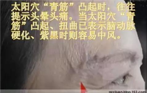 各类青筋的分布和原因,治爆青筋的中药方法