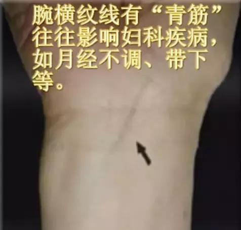 各类青筋的分布和原因,治爆青筋的中药方法