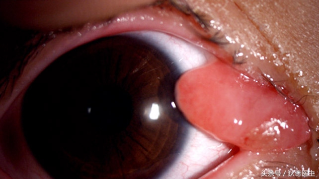 血管瘤系列科普之四,肉芽肿性血管瘤