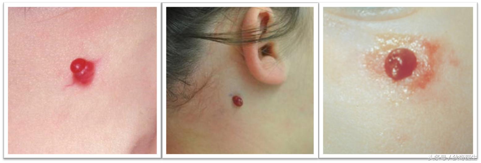 血管瘤系列科普之四,肉芽肿性血管瘤