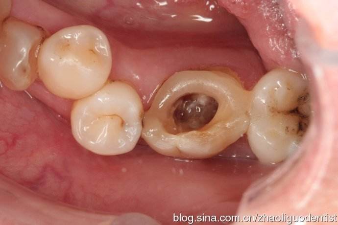 金属托假牙跟树脂托假牙哪种好,哪种假牙是比较好的