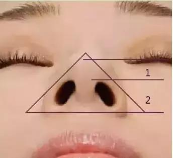 隆鼻手术哪种鼻型不适合,隆鼻手术最大的危险是全麻吗