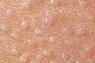 身上起了很多小疙瘩是扁平疣吗,皮肤上长了小米粒大的疙瘩是什么