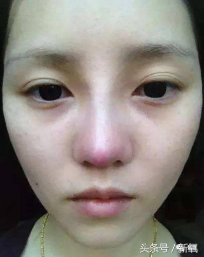 韩安冉这次鼻子修复是在哪修复的,韩安冉现在做的鼻子是什么款的