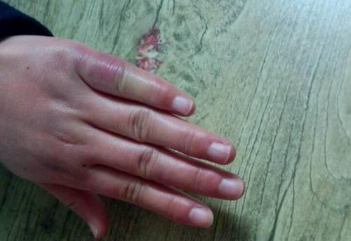 冻伤了以后是不能用热水处理的,冻伤急救后不能立即烤火