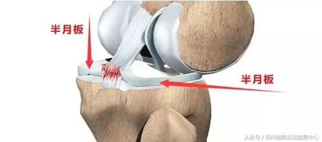 半月板损伤的康复治疗方案,半月板损伤打的是什么针