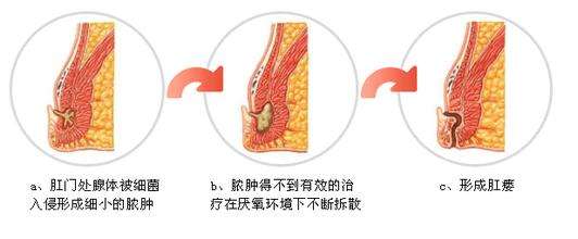 肛瘘怎么预防和治疗,肛瘘怎么治疗怎么预防