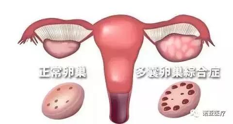 肥胖导致内分泌失调月经紊乱,月经不规律多毛怎么办