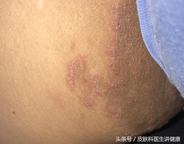 股癣的根部瘙痒起红疙瘩,大腿根股癣是什么引起的