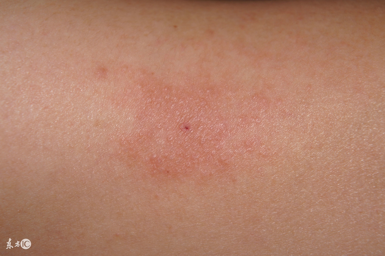 12岁脚上瘊子疣最简单的去除方法,女子祛扁平疣花费近3万