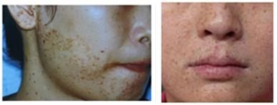 专业激光祛雀斑胎记,激光祛胎记斑痣