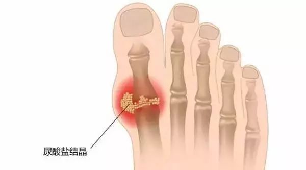 痛风的治疗方法有哪些啊,痛风治疗最好的医院排名