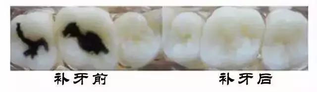 补牙怎么补性价比最高,省口腔医院补牙价格表