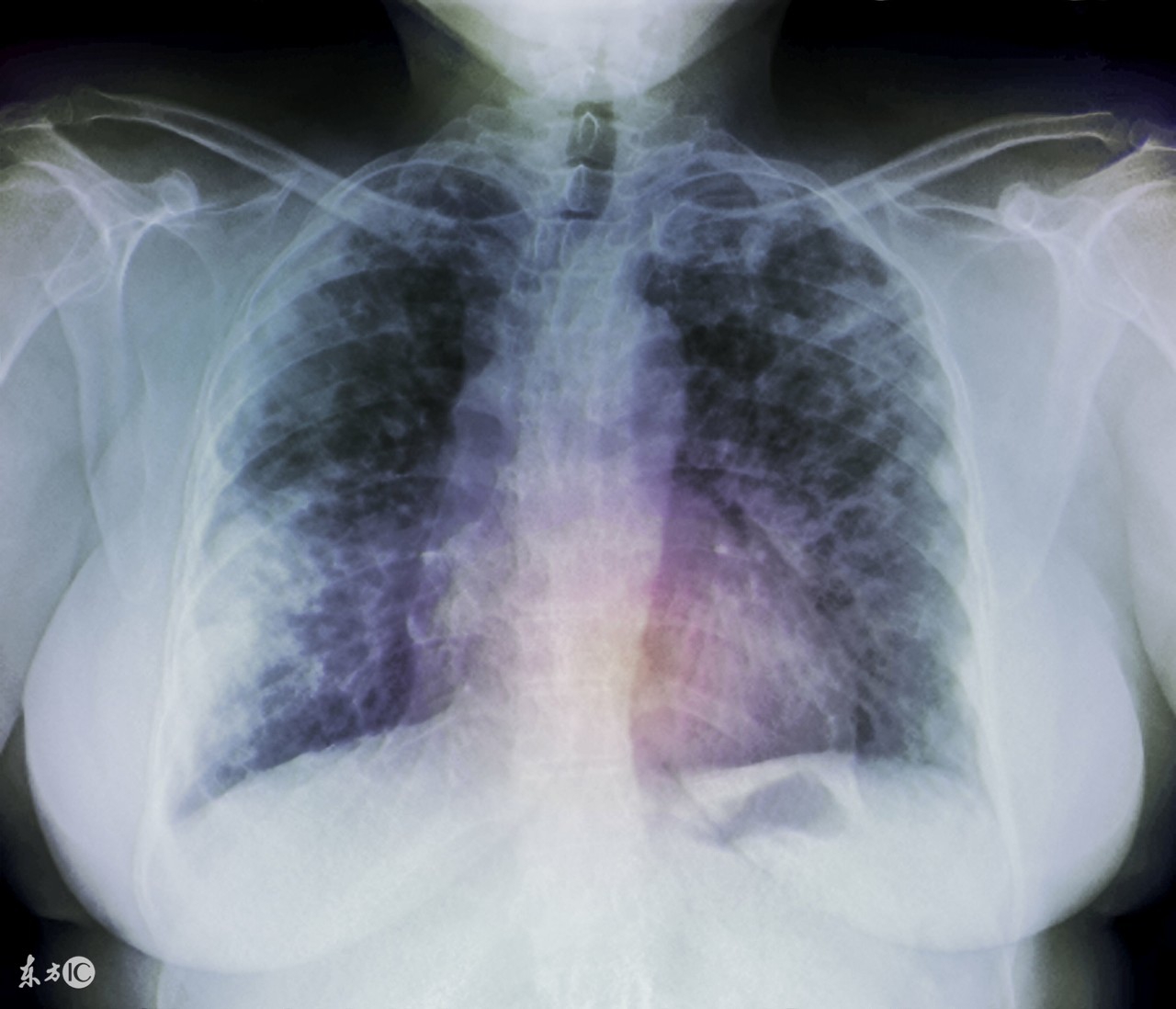 肺腺癌做什么手术最好,肺腺癌转移到胸膜可以手术治疗吗