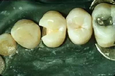 补牙怎么补性价比最高,省口腔医院补牙价格表