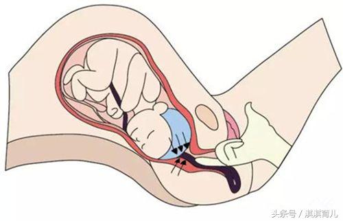 孕晚期胎头低怎么睡好,孕晚期胎头偏小怎么办