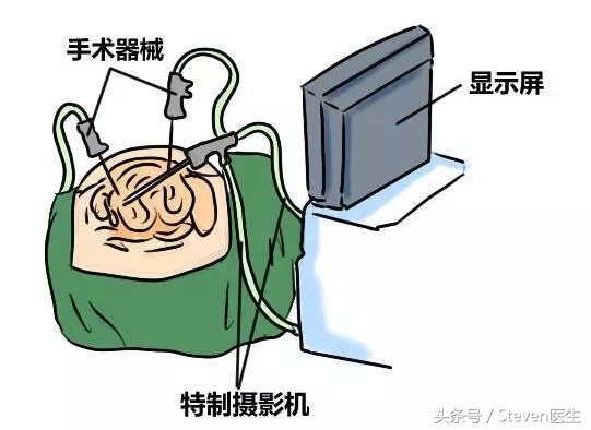 哪些情况做腹腔镜手术,腹腔镜手术的优势及护理课件