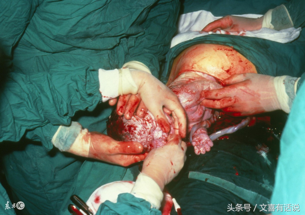 剖宫产对子宫损伤大,剖宫产会不会损伤子宫内膜