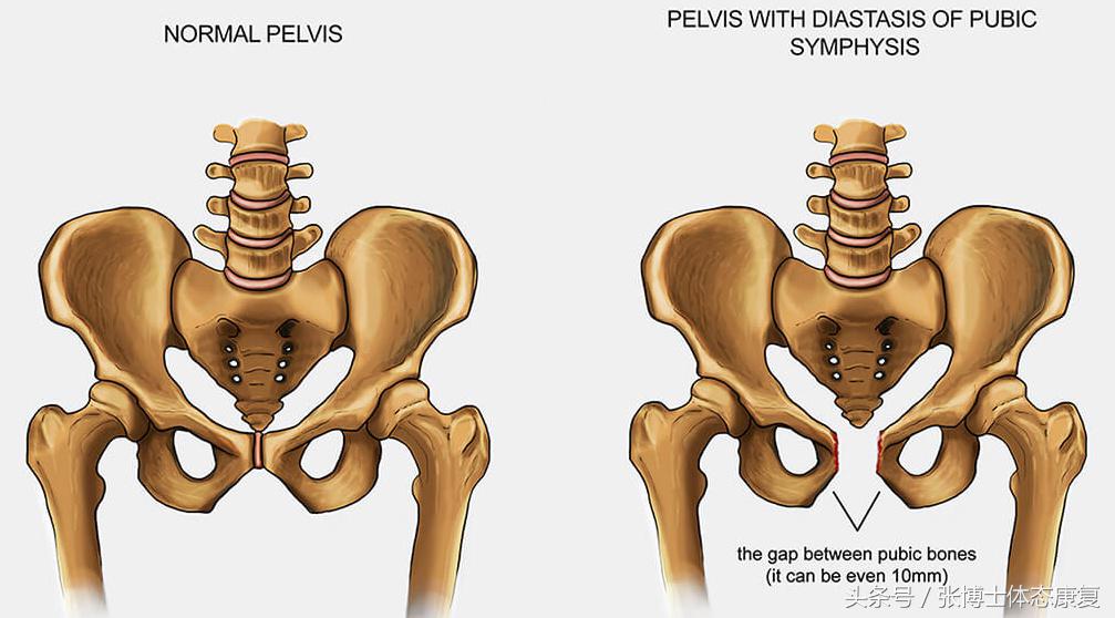 产后耻骨联合分离康复训练,耻骨肌运动康复方案