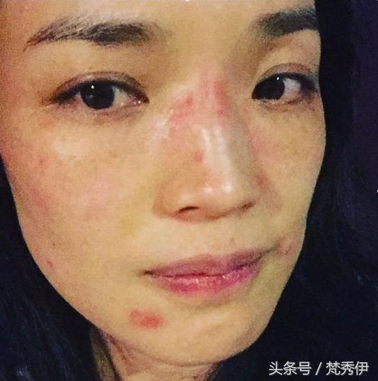 脸过敏发痒发红怎么护肤,脸感觉到刺痛怎么办