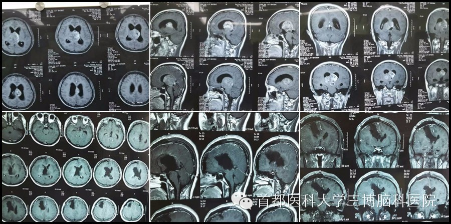 闫长祥脑科视频,闫长祥访谈