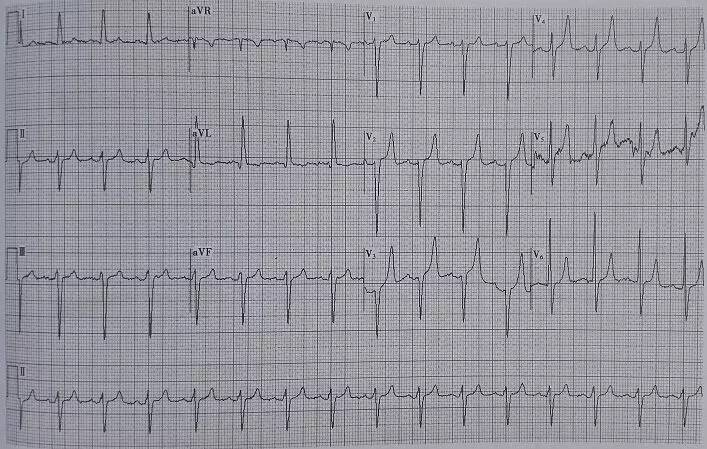 t波高尖st段正常怎么办,t波高尖是怎么引起的