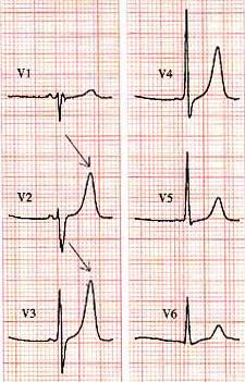 t波高尖st段正常怎么办,t波高尖是怎么引起的