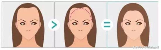 m型发际线日常怎么打理,m型发际线怎么养护和增发