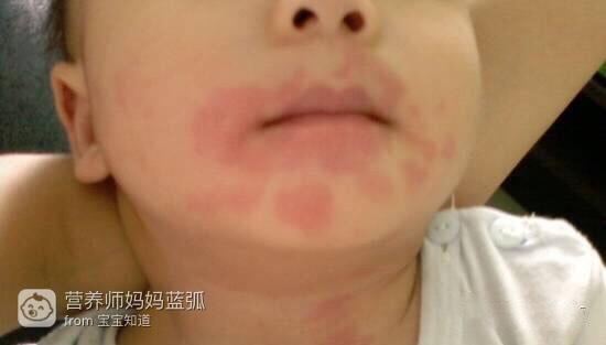 宝宝辅食添加土豆泥过敏了怎么办,蛋白质过敏一岁宝宝辅食食谱大全