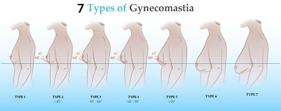 男性自测胸部有没有问题,男性胸越来越大是什么原因呢