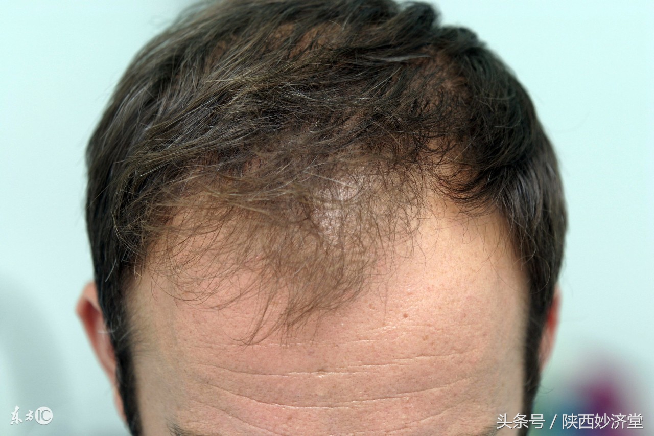 m型发际线日常怎么打理,m型发际线怎么养护和增发